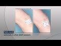 Lumenis leg vein treatment how it works  offered by dr hooman khorasani