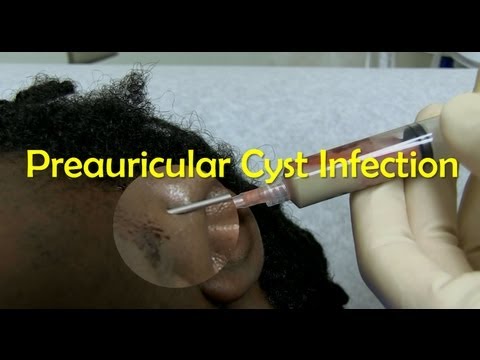 Preauricular Cyst Infection Management