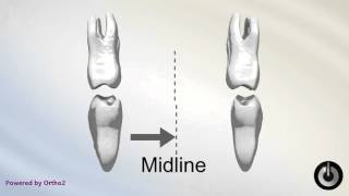 Posterior Crossbite With Functional Shift