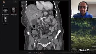 Isolation tutorial: Abdominal CT with Vikas Shah