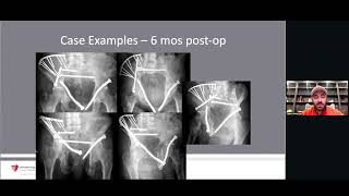Dr. Robert J. Wetzel OTA 2024 Virtual Webinar: Curved Fixation for Tricky Acetabulum Fractures