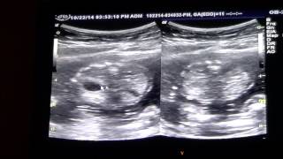 Ultrasound Anatomy Scan - 19 Weeks Pregnant