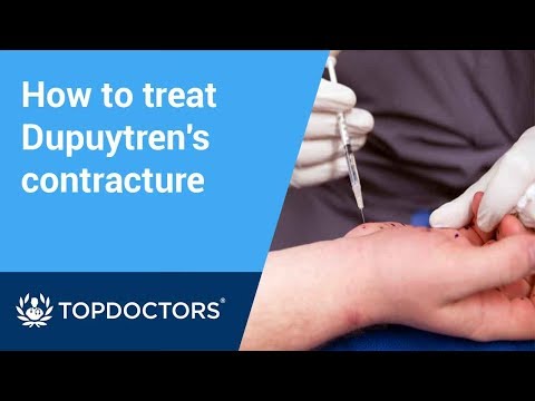 How collagenase injections treat Dupuytren’s contracture