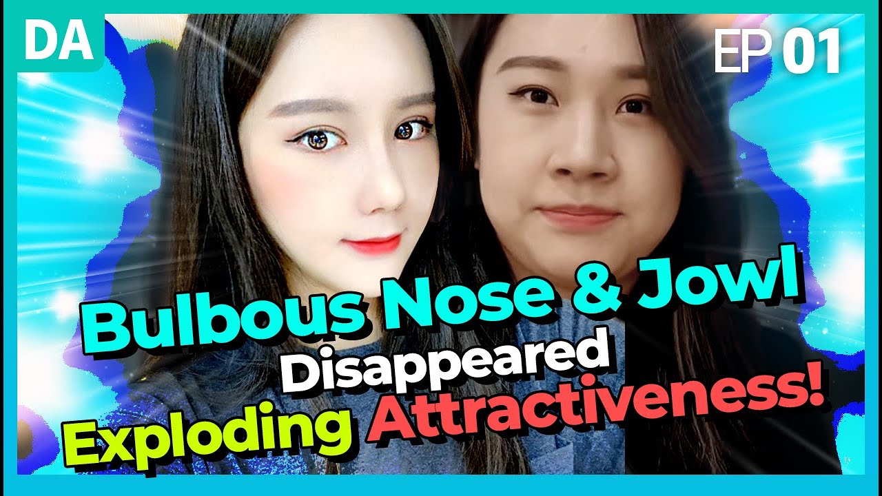 Korea Plastic Surgery | My secret to bulbous nose & jowl surgery in Korea | DA Beauty Clinic