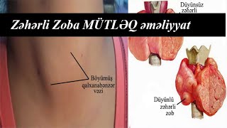 DİQQƏT! Zəhərli Zoba bu halda MÜTLƏQ əməliyyat lazımdır.  Dr.Sadiq Bəbirov