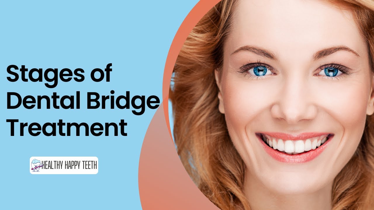 What You Need to Know Before Dental Bridge Treatment | Guide to Dental Bridge Treatment