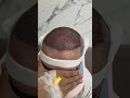 Best Hair Transplant in Islamabad, Pakistan Natural Hairline & Full Density Result #hairtransplant
