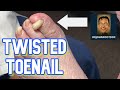 SIDEWAYS THICK Fungal Toenail carved down by podiatrist