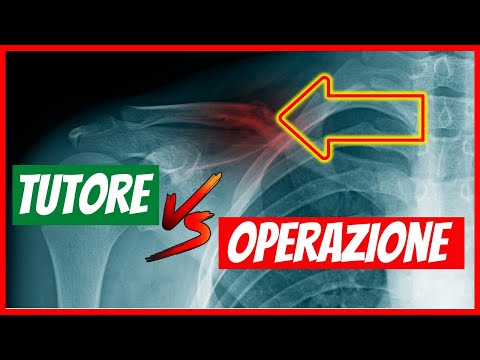 Video: Sintomi, Diagnosi, Trattamento E Cura Della Clavicola Rotta