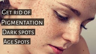 How To Get Rid Of Hyper Pigmentation.|Dark Spots.|Age Spots.
