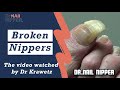 Broken Nippers.  How does Dr Nail Nipper trim toenails?