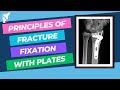 Principles of plates fracture fixation for Orthopaedic  Exams