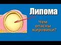 Липома. В чем опасность жировиков?