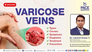 Varicose Veins - Cause, Symptoms, Complications, Treatment and Prevention | Varicose Vein Videos