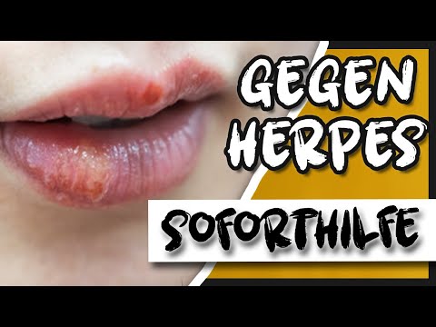 Video: 6 Möglichkeiten, eine Lippenherpes loszuwerden