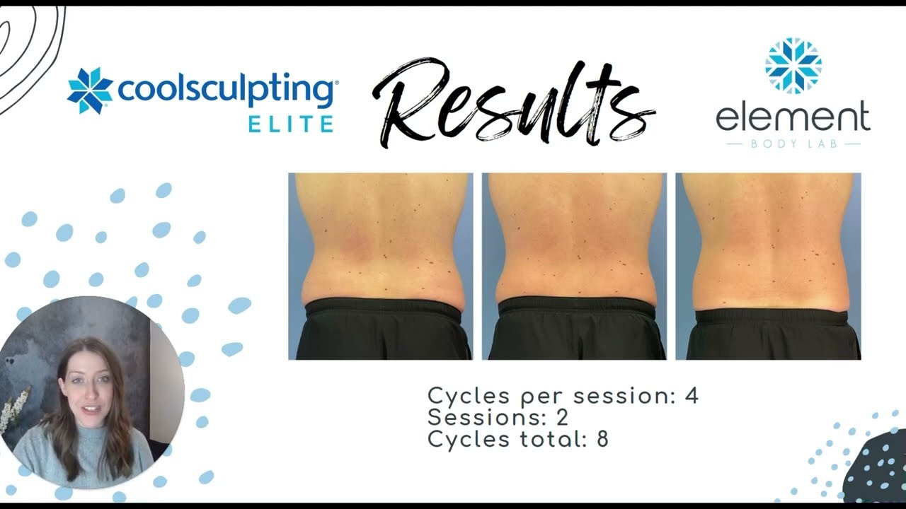 CoolSculpting Elite Male Love Handle Results 2 sessions | Element Body Lab | Dallas, Tx