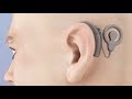 Cochlear Implant Animation