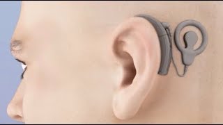 Cochlear Implant Animation