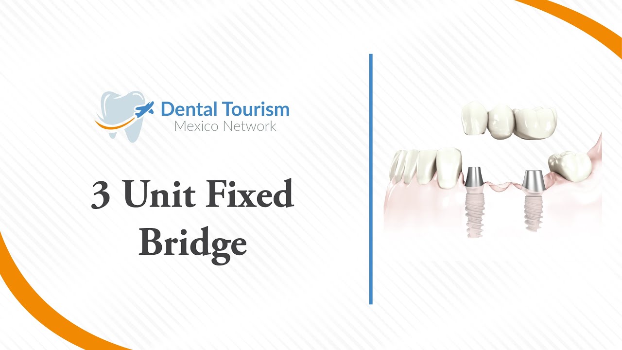 3 Unit Bridge Ciudad de Mexico - Dental Tourism Mexico