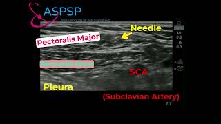 Pectoralis Minor Injection for Thoracic Outlet Syndrome