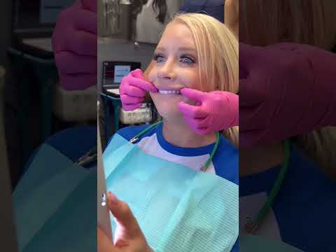 VENEER SMILE TRANSFORM | Veneers by Smile Texas #cosmeticdentistry #smiletransformation #veneers