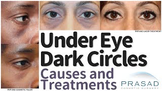 What Causes Under Eye Dark Circles, and How they are Treated