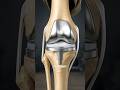 Rebuilding Your Range of Motion: The Critical First Weeks After TKR #MedicalProcedure #Brooklyn