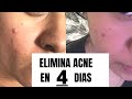 ELIMINA ACNE EN 4 DIAS con CANELA Y TE VERDE || MASCARILLA PARA ELIMINAR ACNE || ELIMINA ACNE RAPIDO