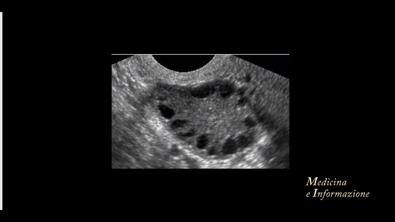 Ovaio policistico: il ruolo della melatonina per regolare il ciclo mestruale