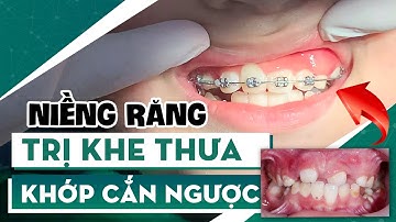 Tháo Niềng Khớp Cắn Ngược Và Khắc Phục Khấp Khểnh Thưa Vùng Răng Cửa