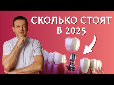 Цена на зубные импланты в 2025 году. В чем их различие ? Какой имплант лучше?