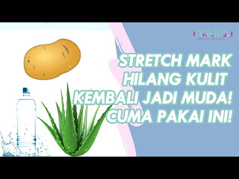 Video: 3 Cara Menghilangkan Stretch Marks di Rumah