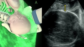 3D measurement of fetal-head symphysis distance (HSD) in labor