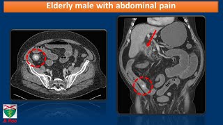 Elderly male with abdominal pain
Speaker: Dr. Balaji Rao, MBBCh
Assistant Professor, Emergency Radiology and Neuroradiology,
Dept of Radiology and Biomedical Imaging,
Yale University School of Medicine Elderly male with abdominal pain