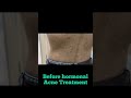 Back acne treatment  acne spots  hormonal acne dermatologist in punjab drashimagoel shorts