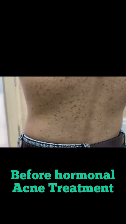 Back Acne Treatment | Acne spots | hormonal acne |Dermatologist in Punjab #drashimagoel #shorts