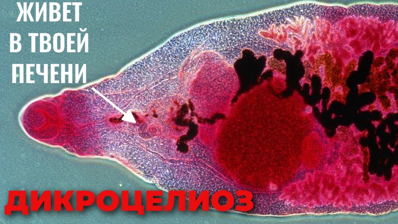 ДИКРОЦЕЛИОЗ - возбудитель, морфология, цикл развития, диагностика, профилактика, лечение