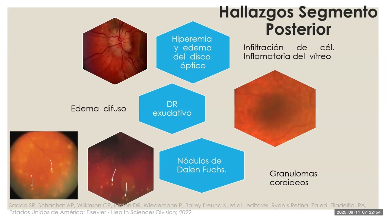 Oftalmia Simpática (OS)