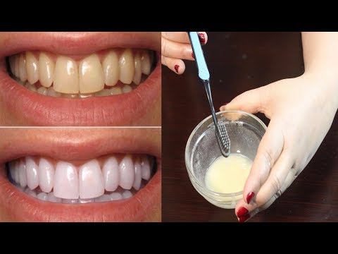 How To Whiten Teeth - Best Teeth Whitening Method - Teeth Whitening At Home