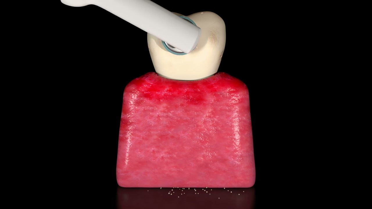 Zahnstein und Zahnbelag entfernen