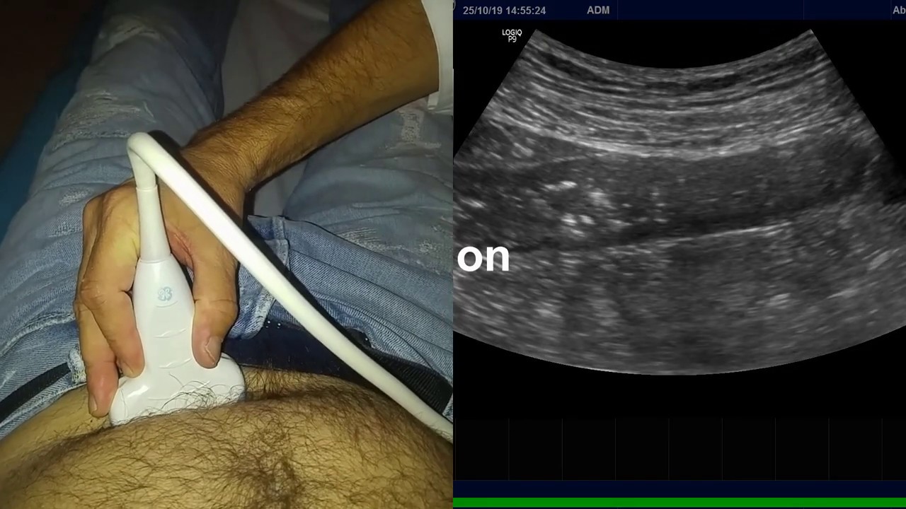 Echographie digestive : Rectocolite hémorragique échographie  Pancolite  grave examen d'urgence