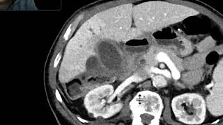 Perforated cholecystitis
Speaker: Dr. Mahan Mathur, MD.
Associate Professor, Division of Body Imaging,
Vice Chair of Education, Dept of Radiology and Biomedical Imaging,
Yale University School of Medicine Perforated cholecystitis