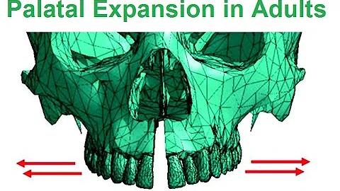 Is Palatal Expansion Possible In Adults By Dr Mike Mew
