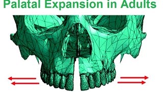 Is Palatal Expansion Possible In Adults By Dr Mike Mew