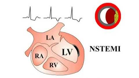3.4 NSTEMI và cơn đau thắt ngực không ổn định-vietsub