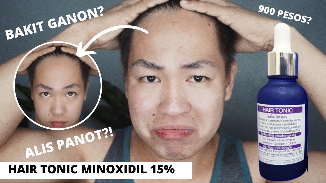 E1 • HAIR MINOXIDIL 15% ONE WEEK! IS REALLY EFFECTIVE?! - YouTube
