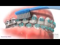 Proper Brushing Technique - Braces