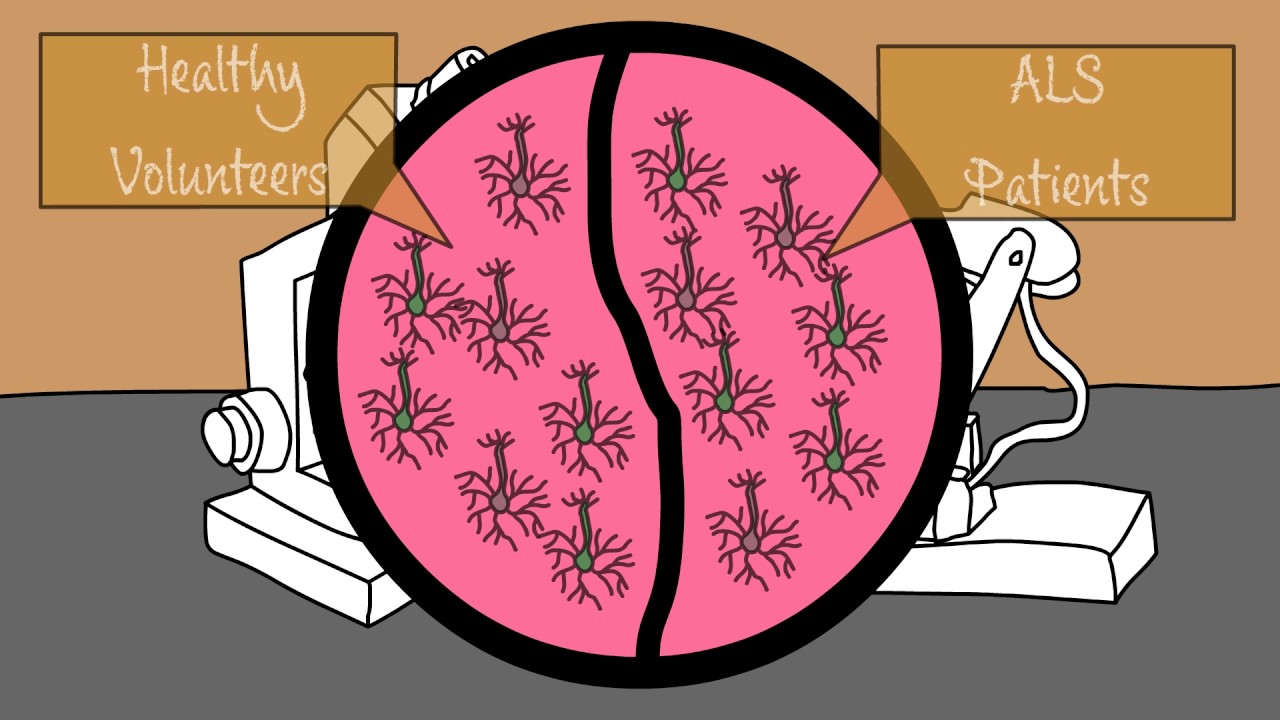 The Role of RNA Binding Protein hnRNP A2/B1 in ALS