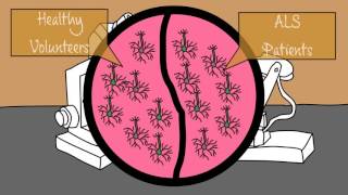 The Role Of Rna Binding Protein Hnrnp A2B1 In Als