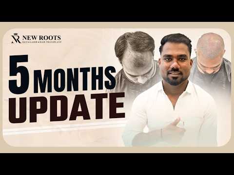 5 Months, 3000 Grafts, & 100% Satisfaction | Hair Transplant in Nagpur | New Roots